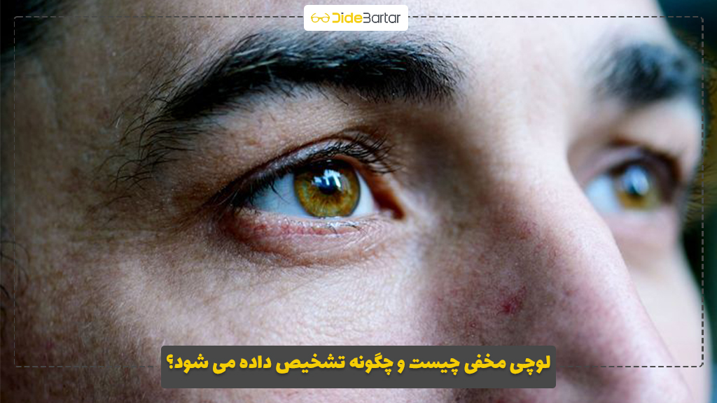 لوچی مخفی چیست و چگونه تشخیص داده می‌ شود؟