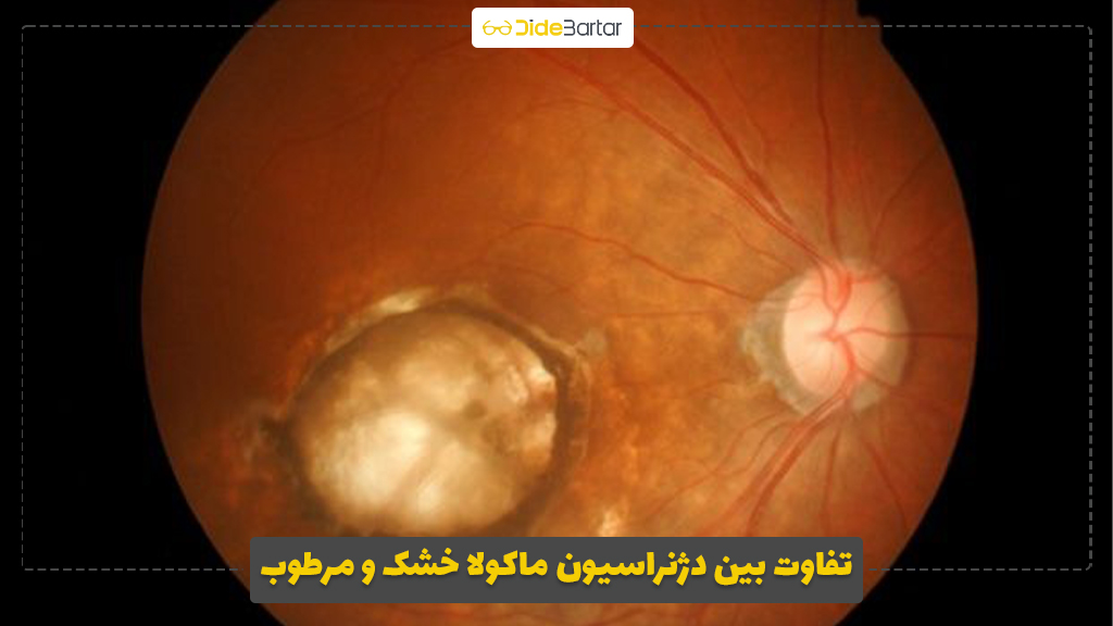 تفاوت بین دژنراسیون ماکولا خشک و مرطوب