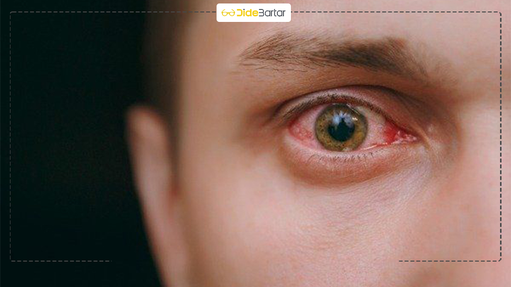 کاربرد‌ های لنز اسکلرال در بیماران خاص