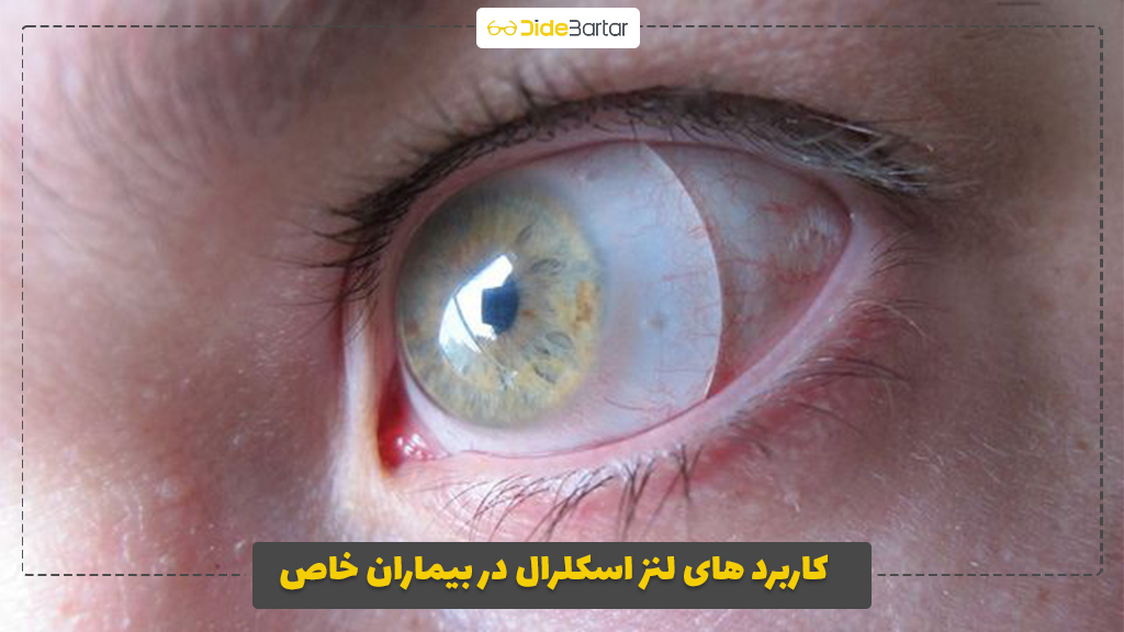 کاربرد‌ های لنز اسکلرال در بیماران خاص