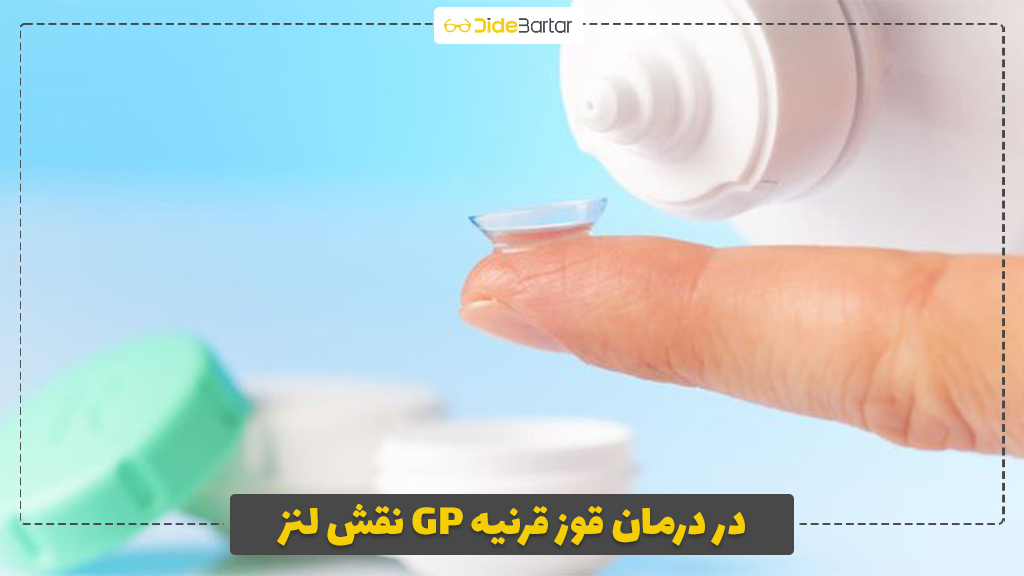 نقش لنز GP در درمان قوز قرنیه
