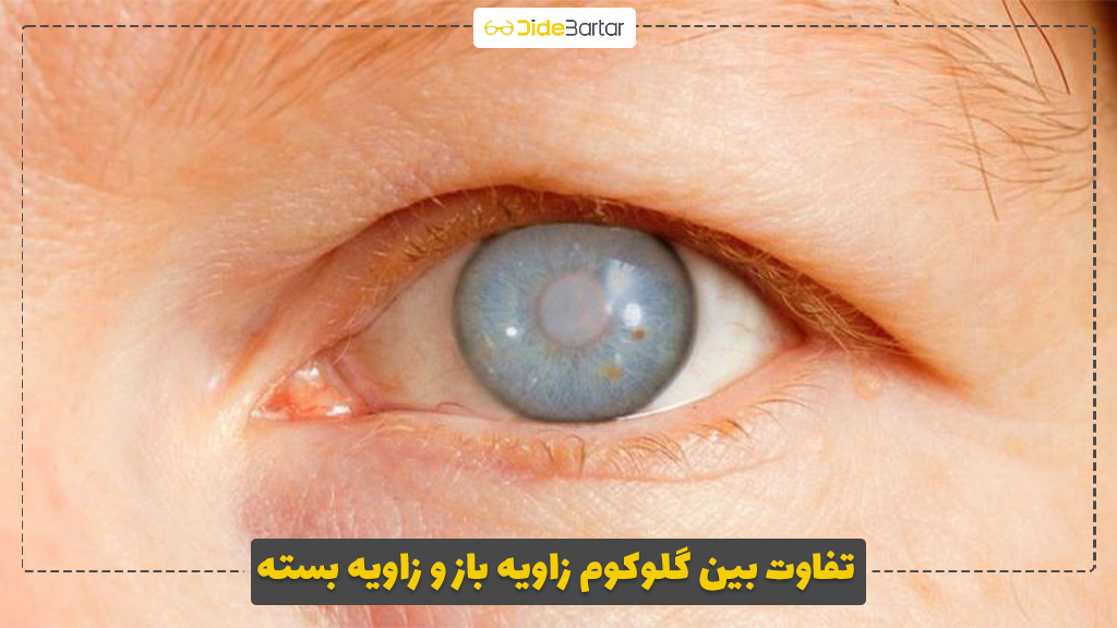تفاوت بین گلوکوم زاویه باز و زاویه بسته
