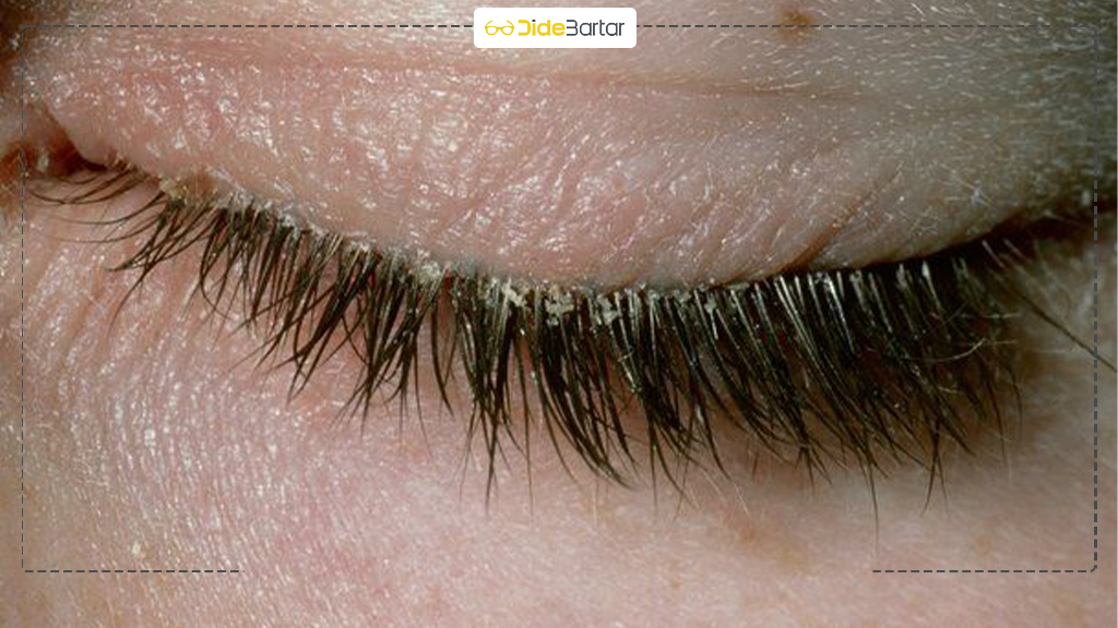 عفونت‌ های چشمی شایع و نحوه پیشگیری