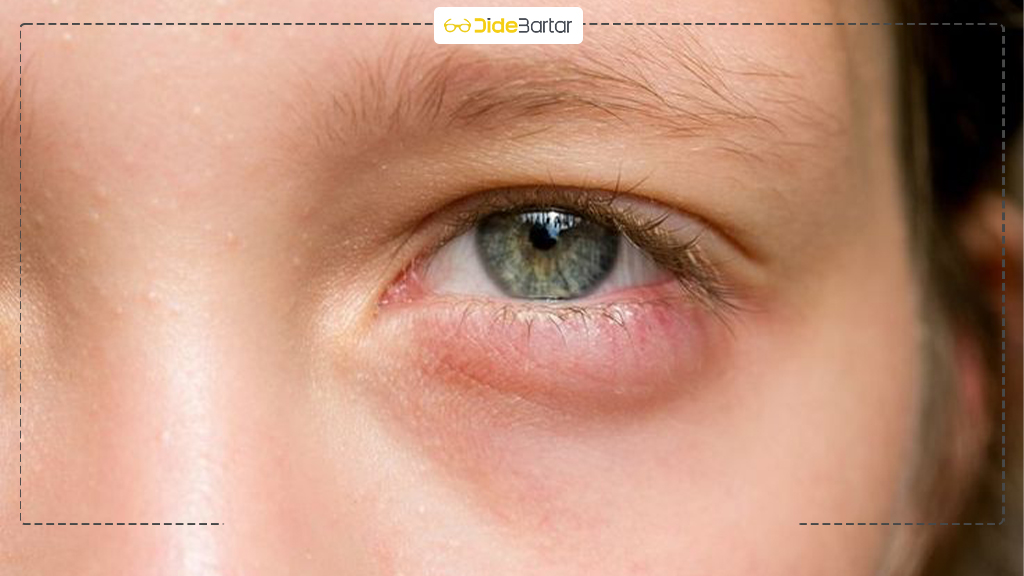 عفونت‌ های چشمی شایع و نحوه پیشگیری