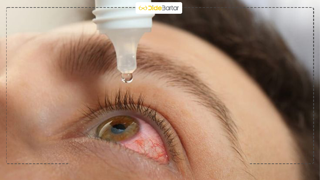 عفونت‌ های چشمی شایع و نحوه پیشگیری