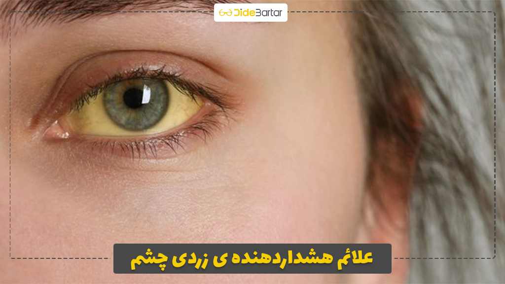 علائم هشداردهنده‌ ی زردی چشم