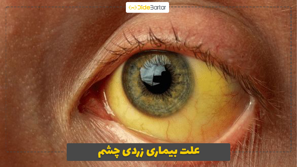 علت بیماری زردی چشم