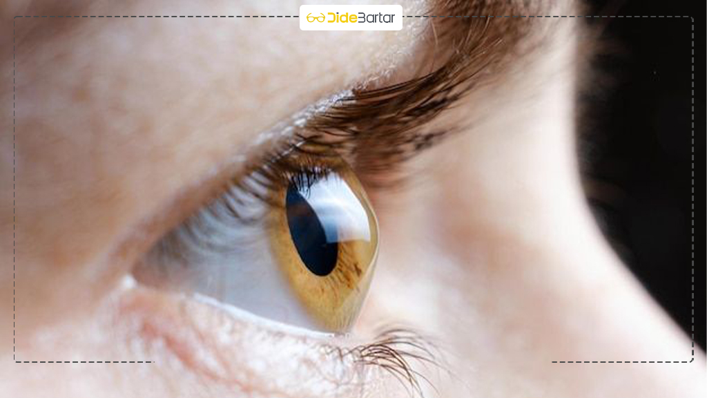 تفاوت آستیگماتیسم با قوز قرنیه