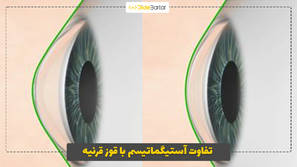 تفاوت آستیگماتیسم با قوز قرنیه