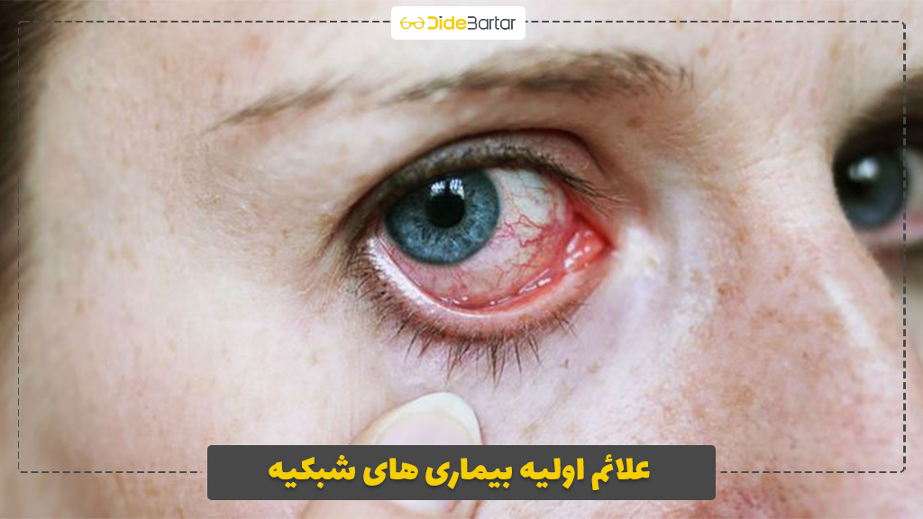 علائم اولیه بیماری‌ های شبکیه