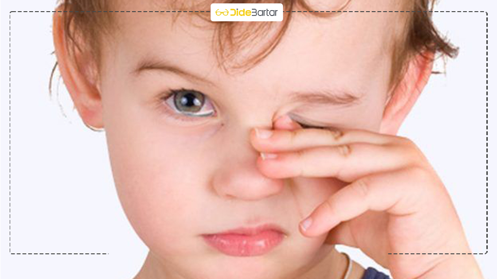 علائم پنهان انحراف چشم