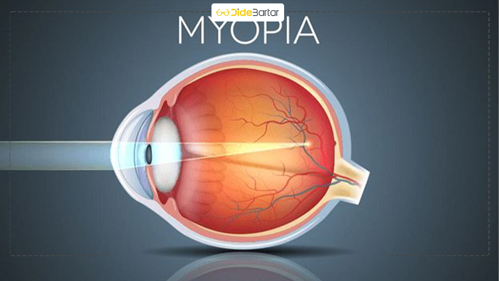 راه های پیشگیری از افزایش نزدیک‌بینی