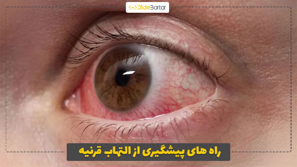 راه های پیشگیری از التهاب قرنیه