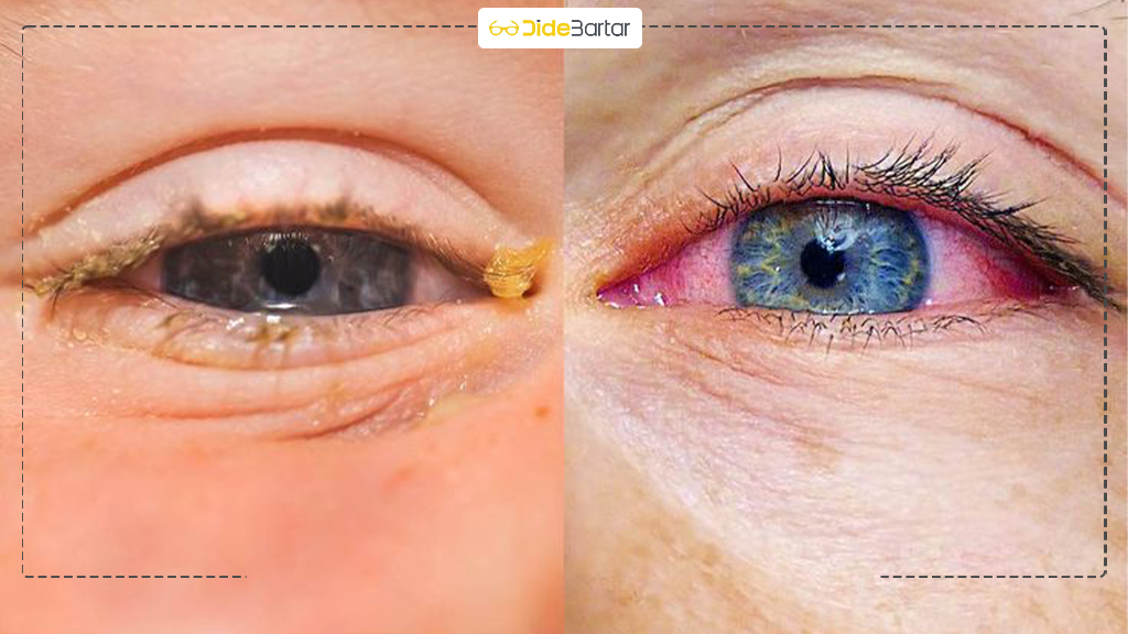 تفاوت بین خشکی چشم و آلرژی چشمی