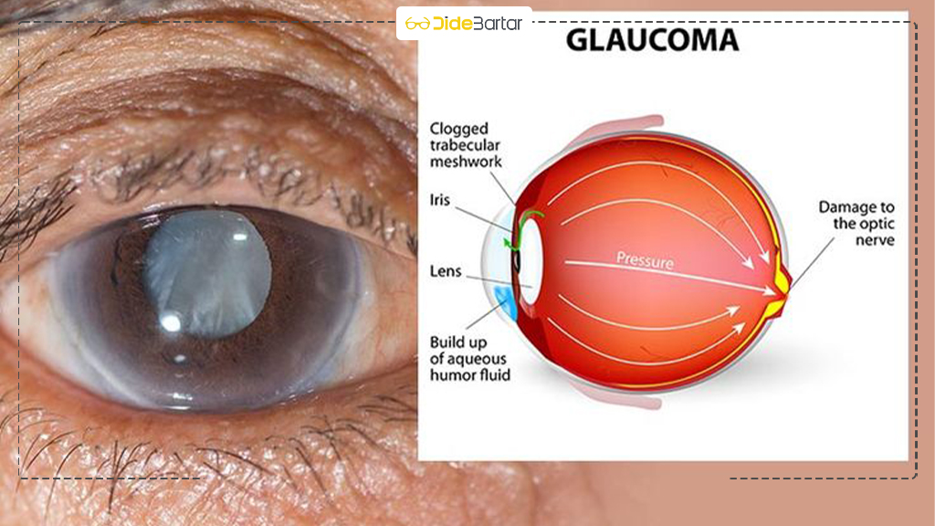 شایع‌ ترین مشکلات بینایی در سالمندان و روش پیشگیری