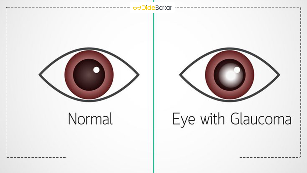 علائم اولیه گلوکوم که نباید نادیده بگیرید
