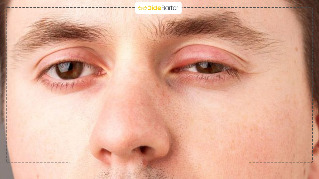 علائم حساسیت فصلی چشم