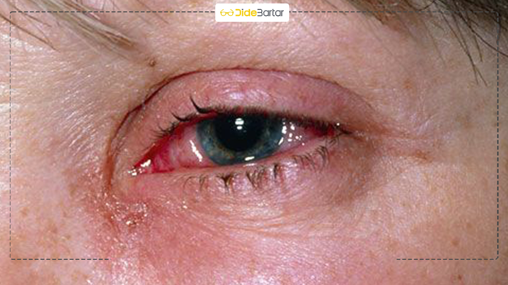 علائم حساسیت فصلی چشم