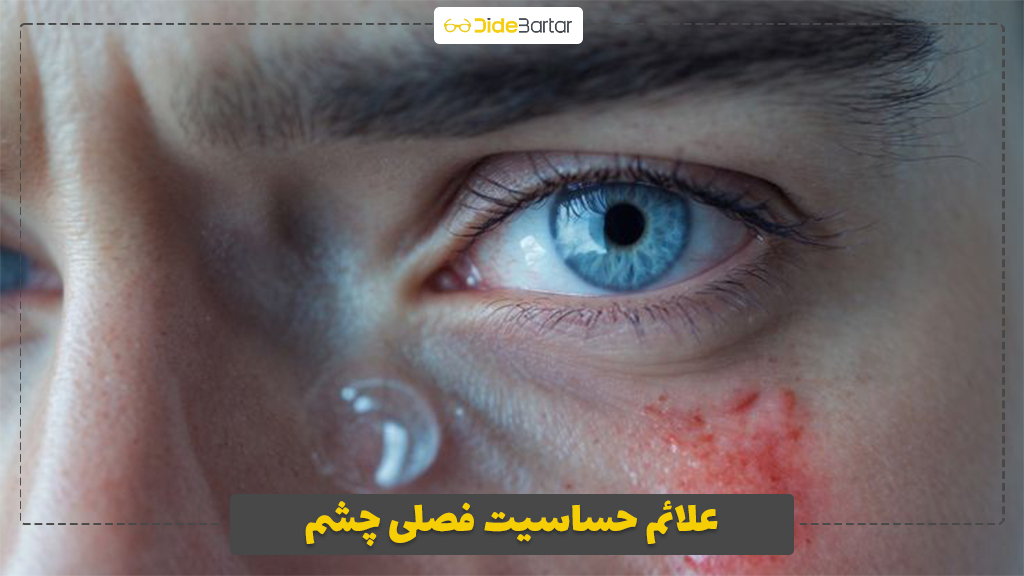 علائم حساسیت فصلی چشم