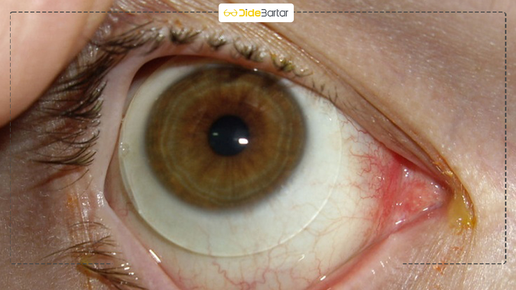 نکاتی که در انتخاب لنز اسکلرال باید رعایت کرد